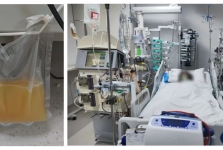 山东大学齐鲁医院（青岛）重症医学科成功开展双重血浆置换技术，为重症患者救治再添利器