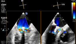 山东大学齐鲁医院（青岛）心内科团队应用 DragonFly™再度完成高危复杂二尖瓣极重度反流 TEER 手术
