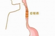 探索实践树特色——我院胸外科食管亚专业优化吻合流程有效降低术后吻合口瘘