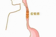 探索实践树特色——我院胸外科食管亚专业优化吻合流程有效降低术后吻合口瘘