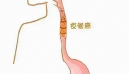 探索实践树特色——我院胸外科食管亚专业优化吻合流程有效降低术后吻合口瘘