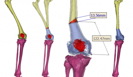 保“膝”有术 | 截骨矫形——破解行走疼痛，守护关节健康