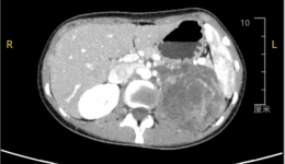 术业求精 | 23岁姑娘“怀”10cm巨瘤，我院微创手术“拆弹”成功，美丽不留痕