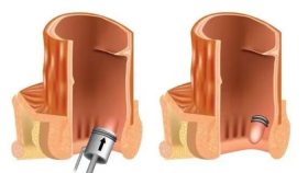 术业求精 | 九旬老人重获舒心生活，微创套扎术破解高龄痔疮患者手术难题