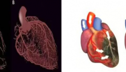 健康科普 | 增强型体外反搏的临床应用