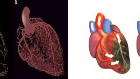 健康科普 | 增强型体外反搏的临床应用