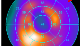 健康科普 | 冠心病搭桥手术前是否有必要做PET/CT心肌活性测定？