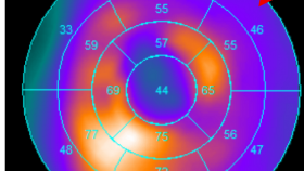 健康科普 | 冠心病搭桥手术前是否有必要做PET/CT心肌活性测定？