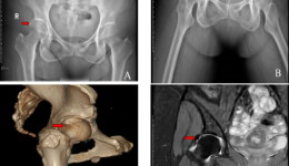 精准微创除钙化，重建盂唇护髋稳——我院运动医学科成功开展髋关节镜下盂唇重建术