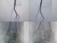 介入新技术系列（八）：我院介入科开展膝动脉栓塞治疗术