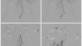 介入新技术系列（九）：我院介入科开展痔疮动脉栓塞术