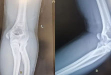 别让友谊的小船说翻就翻——14岁少年“掰手腕”，竟致肱骨内上髁骨折！