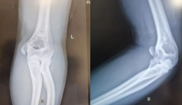 别让友谊的小船说翻就翻——14岁少年“掰手腕”，竟致肱骨内上髁骨折！