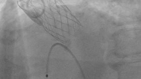 88岁老人陷“心衰重症”绝境！我院多学科协作+ECMO护航，微创TAVR 90分钟救“心”