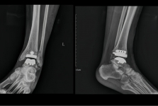 精准置换 迈步新生｜关节外科成功开展 3D 打印辅助全踝关节置换术