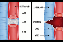 主动脉夹层——认识这个“血管杀手”